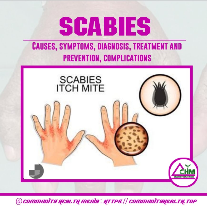 Scabies : Causes, symptoms, diagnosis, treatment, prevention and complications